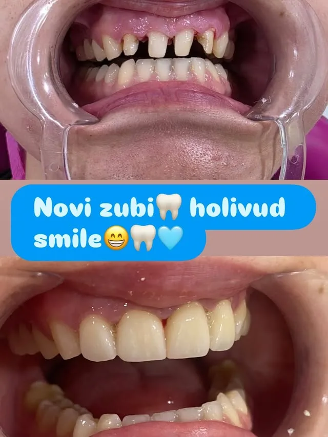 Objava: novi zubi, prije i poslije