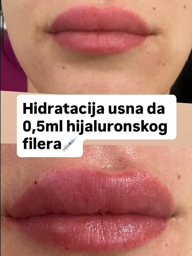 Objava: hidratacija usana hijaluronskim filerom