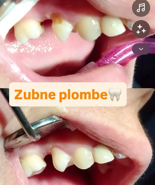 Objava: zubne plombe